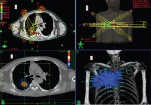 lung metastasis receiving high dose precise radiotherapy with stereotactic technology