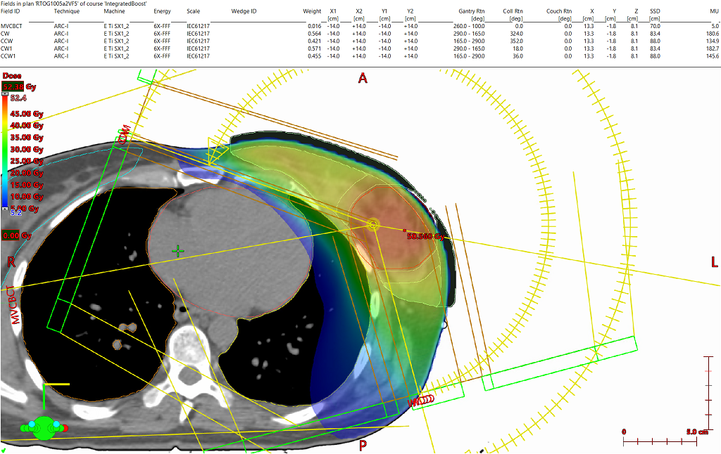 vmat breast radiotherapy