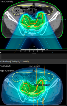 Proton Therapy for prostate cancer.